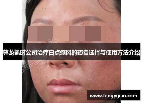 尊龙凯时公司治疗白点癫风的药膏选择与使用方法介绍 尊龙凯时公司治疗白点癫风的药膏选择与使用方法介绍