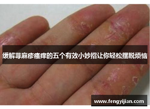 缓解荨麻疹瘙痒的五个有效小妙招让你轻松摆脱烦恼